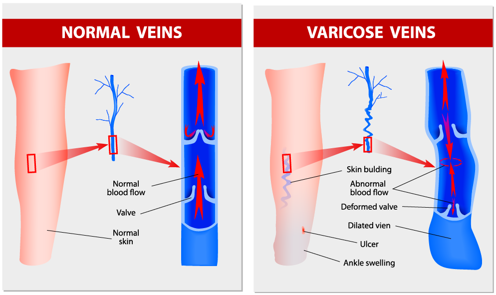Normal veins vs varicose veins
